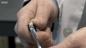 Composite filling material